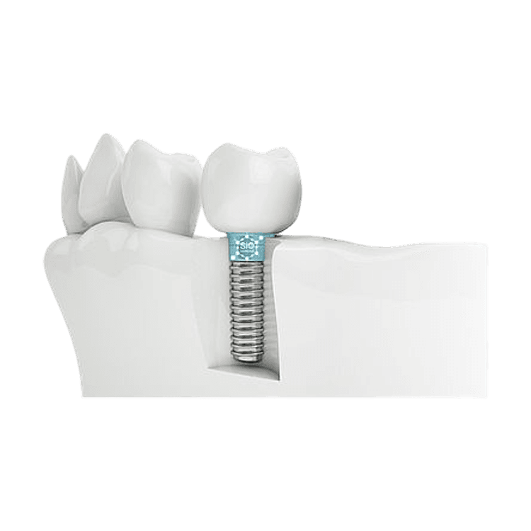Implantcoat