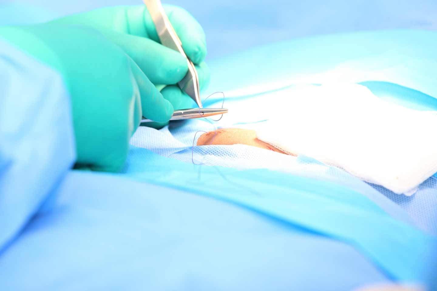 Surgeon performing a surgical procedure using a needle and suture thread on a patient in a clinical setting.